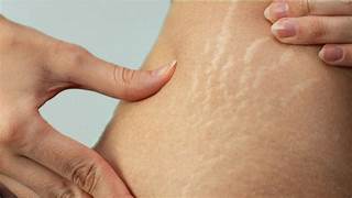 Stretch Mark Removal Treatment in India – Professional Care for Noticeable Skin Improvement & Smoother Skin | Essence Skin Care stretch marks removal treatment
