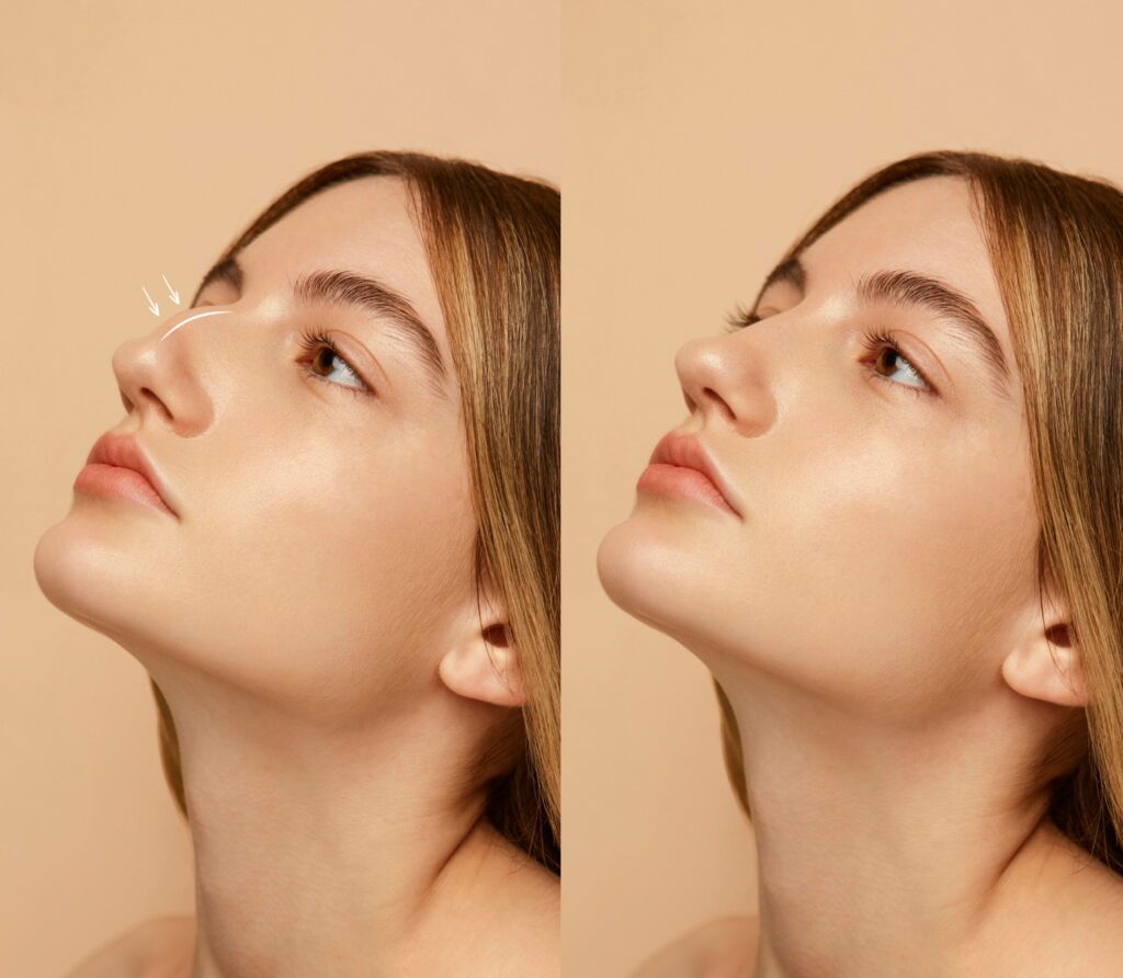 rhinoplasty before and after