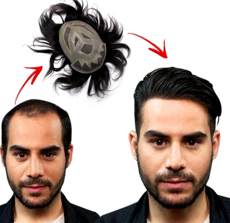 Losing Your Hair Doesn't Mean Losing Your Confidence — Here's What's Changed Losing Your Hair Doesn't Mean Losing Your Confidence — Here's What's Changed